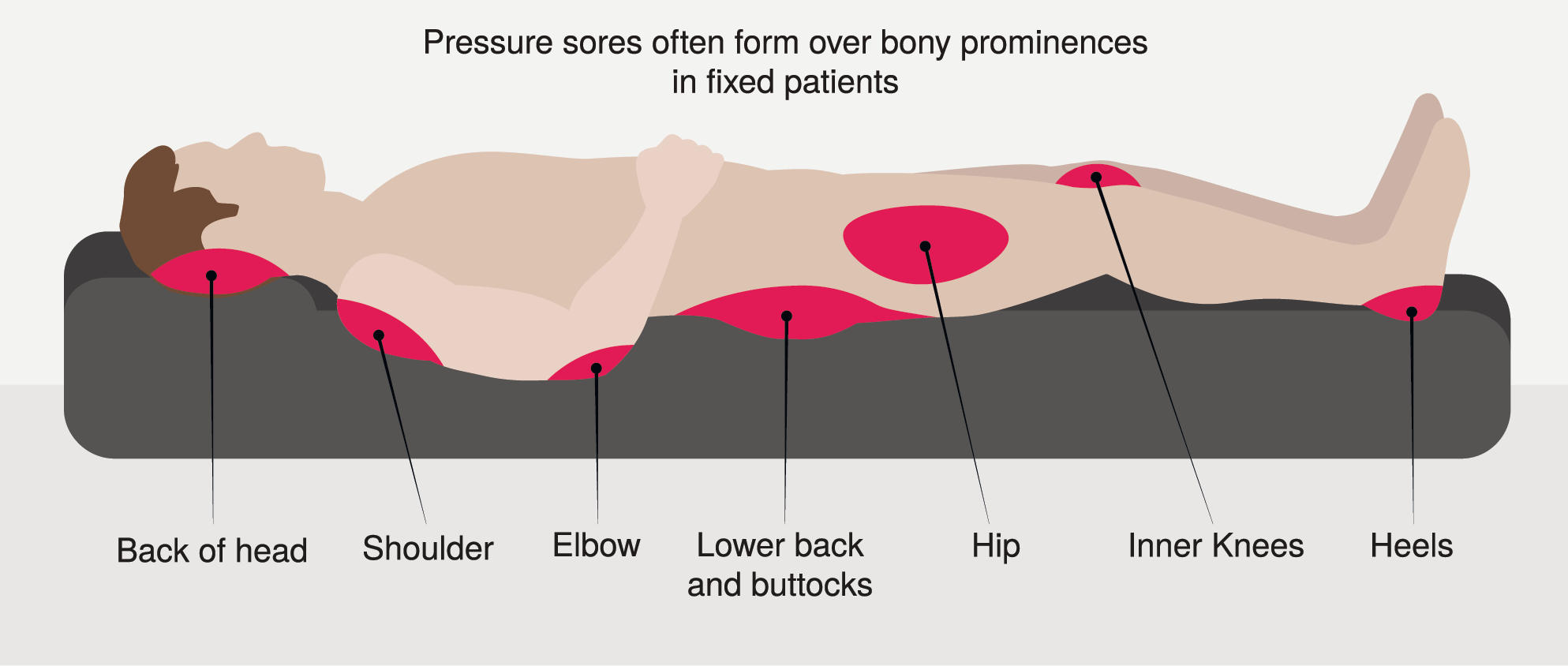 Pressure Injury 101 Stage 2 Pressure Ulcers